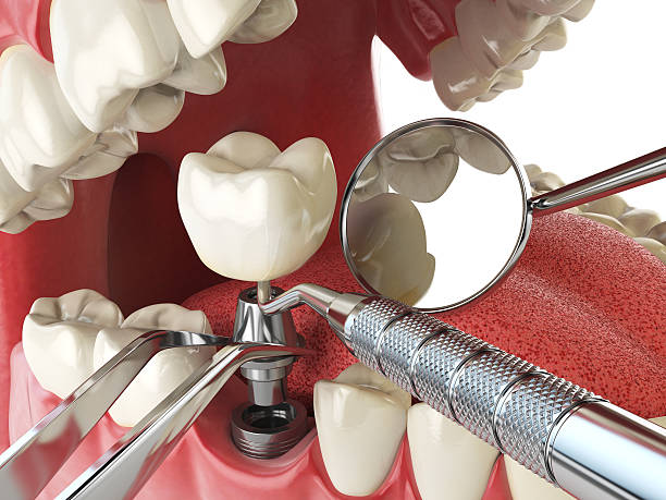 Best Emergency Tooth Extraction in Crawford, GA